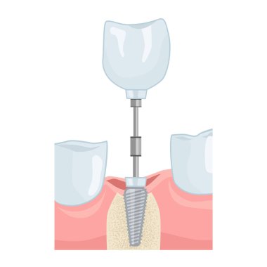 Diş implantı yerleştirildi. Diş Hizmetleri. Diş kitapları için illüstrasyon