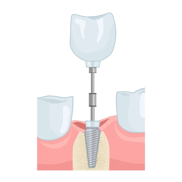 Inserción Implantes Dentales Servicios Dentales Ilustración Para Libros Texto Dentales — Archivo Imágenes Vectoriales