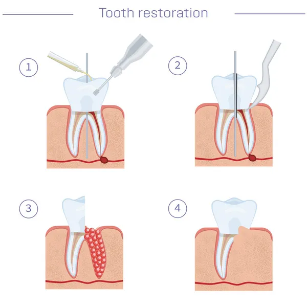 Tratamiento Dental Instrucciones Paso Paso Hemisección Remoción Raíces Odontología Moderna — Vector de stock