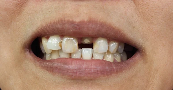 Close-up van slechte tanden — Stockfoto