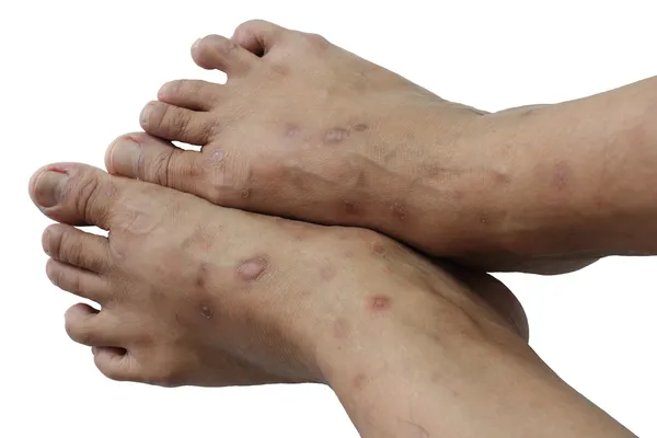 Psoriasis is een chronische — Stockfoto