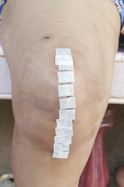 Knieersatzschnitt — Stockfoto