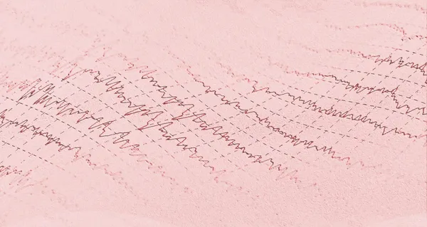 Електроенцефалограма хвилі мозку ЕЕГ для епілепсії — стокове фото