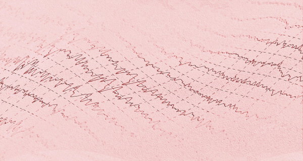 Brain wave electroencephalogram EEG for epilepsy