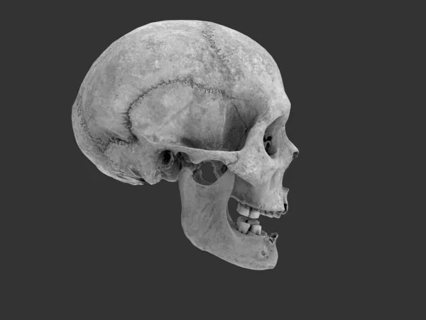 Cráneo Humano Con Dientes Faltantes Vista Lateral — Foto de Stock