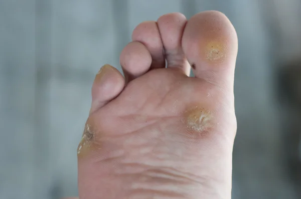 ayak siğil, Mısır