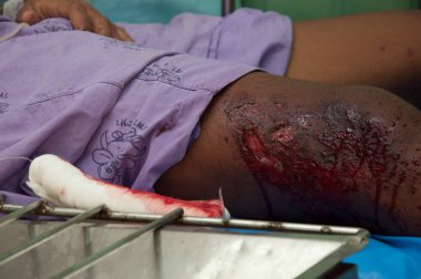 yala, Tayland - Şubat 23: askerin bacak yarası saatli bomba