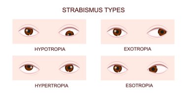 Strabismus tipi. Hipotrop, hipertropia, ekzotrop, esotropi. Farklı şaşı hastalıkları olan insan gözleri. Çarpraz göz durumu