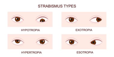 Strabismus types. Hypotropia, hypertropia, exotropia, esotropia. Human eyes with different squint disorders. Crossed eyes condition clipart
