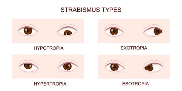 Tipos de estrabismo. Hipotropía, hipertropía, exotropía, esotropía. Ojos humanos con diferentes trastornos del entrecejo. Condición de los ojos cruzados — Vector de stock