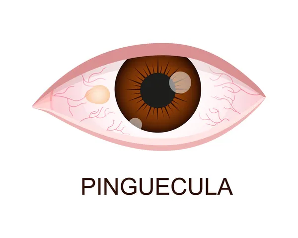 Pinguecula. Conjunctival degeneration. Eye disease. Human organ of vision with pathology. Vector realistic illustration — Stock Vector