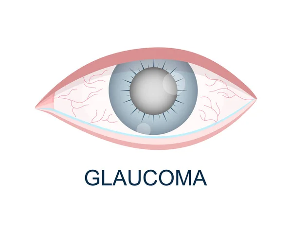 Eye with glaucoma closeup view. Hazy, redness, watery eyeball. Anatomically accurate human organ of vision. Aging visual problems. Vector illustration — Stock Vector