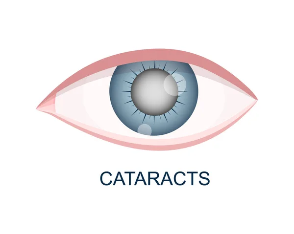 눈을 가까이에서 바라보고 있습니다. 흐릿 한 렌즈가 달린 안구. 노화 문제가 있는 해부학적으로 정확 한 인체 시각 기관 — 스톡 벡터