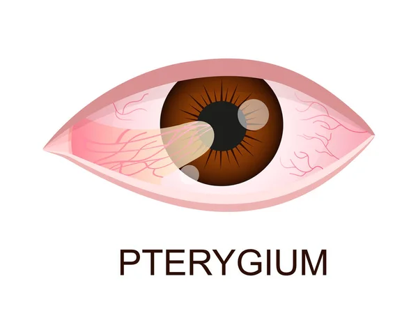 Pterygium rosnące na rogówce. Zwyrodnienie spojówek. Choroba oczu. Ludzki organ wzroku z patologią. Wektor realistyczny ilustracja — Wektor stockowy