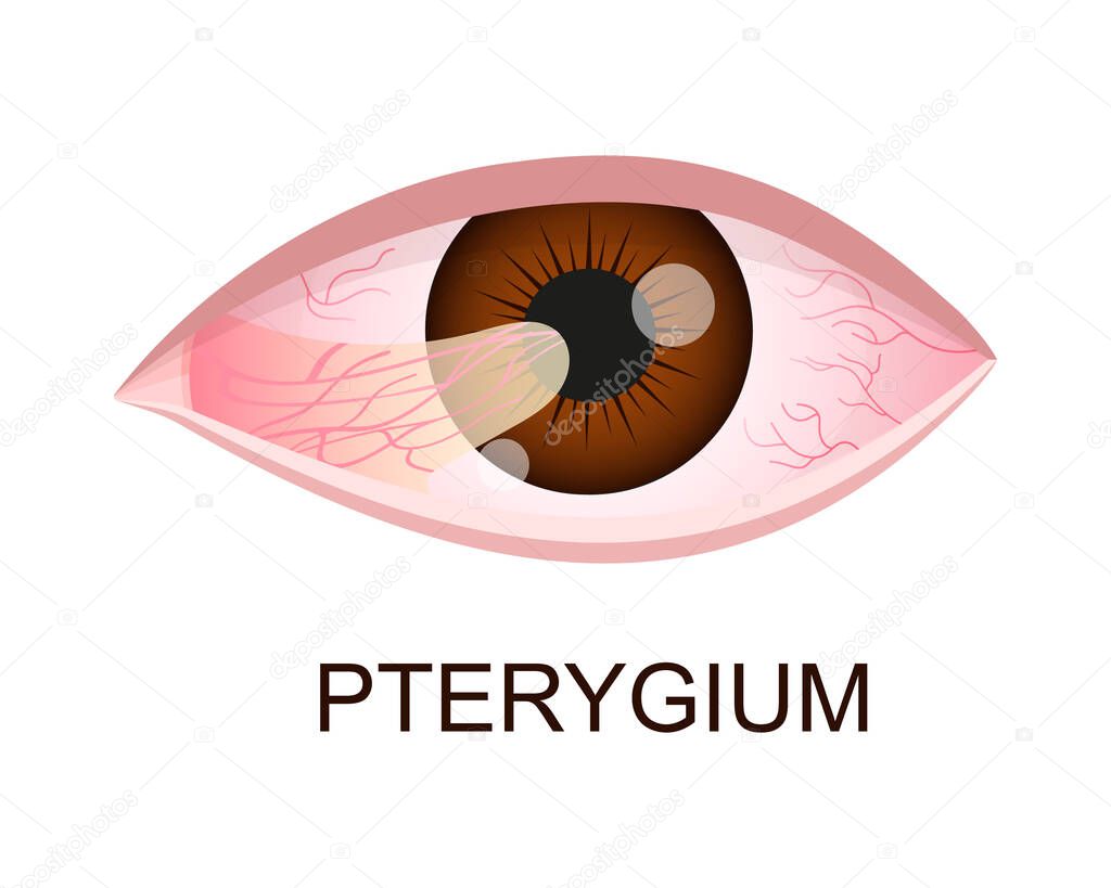 Pterygium growing onto the cornea. Conjunctival degeneration. Eye disease. Human organ of vision with pathology. Vector realistic illustration