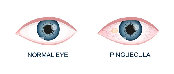 Ojo sano y con pinguécula. Degeneración conjuntival antes y después de la cirugía. Enfermedad ocular. Órgano de visión humano con patología — Archivo Imágenes Vectoriales