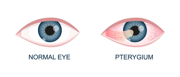 Ojo sano y con pterigión. Degeneración conjuntival antes y después de la cirugía. Enfermedad ocular. Órgano de visión humano con patología — Vector de stock