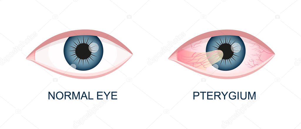 Eye healthy and with pterygium. Conjunctival degeneration before and after surgery. Eye disease. Human organ of vision with pathology