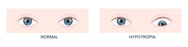 Hipotropik. Dikey strabismus. İnsan gözleri sağlıklı ve aşağıya doğru bakıyor. Çift görüş. Vektör çizgi film illüstrasyonu