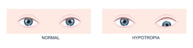 Hypotropia. Vertical strabismus. Human eyes healthy and with downward gaze position. Double vision. Vector cartoon illustration clipart