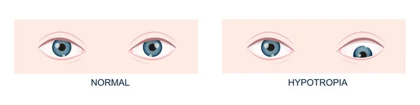Hypotropia. Vertical strabismus. Human eyes healthy and with downward gaze position. Double vision. Vector cartoon illustration — Stock Vector