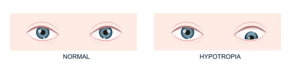 Hipotropik. Dikey strabismus. İnsan gözleri sağlıklı ve aşağıya doğru bakıyor. Çift görüş. Vektör çizgi film illüstrasyonu