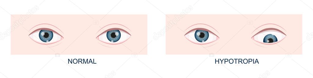 Hypotropia. Vertical strabismus. Human eyes healthy and with downward gaze position. Double vision. Vector cartoon illustration