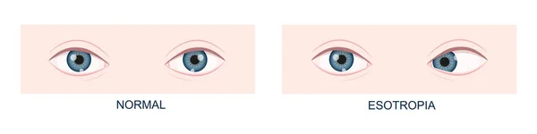 Esotropia. Horizontal strabismus before and after surgery. Eye misalignment, cross-eyed condition. Human eyes healthy and with inward gaze position — Stock Vector