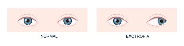 Exotropia. Horizontal strabismus before and after surgery. Eye misalignment, cross-eyed condition. Human eyes healthy and with outward gaze position — Stock Vector