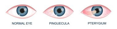 Göz sağlığı yerinde, kornea üzerinde pinguecula ve pterygium büyüyor. Konjonktival dejenerasyon. Göz hastalığı. Patolojisi olan insan görme organı.
