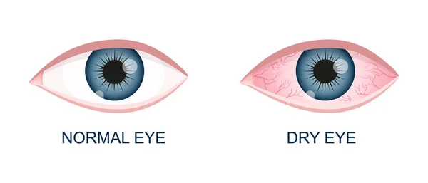 Ojo humano sano y seco. Ojo inyectado en sangre normal e inflamado con irritación y conjuntiva roja. Síntomas de queratitis, alergia, conjuntivitis, uveítis. Dibujos animados vectoriales ilustración — Archivo Imágenes Vectoriales