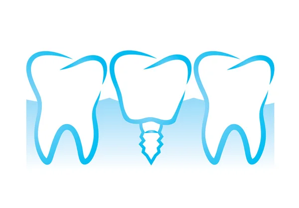 Ilustración del implante dental — Vector de stock