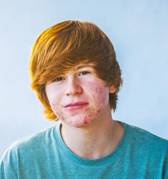 Smart boy in puberty with acne — Stock Photo, Image