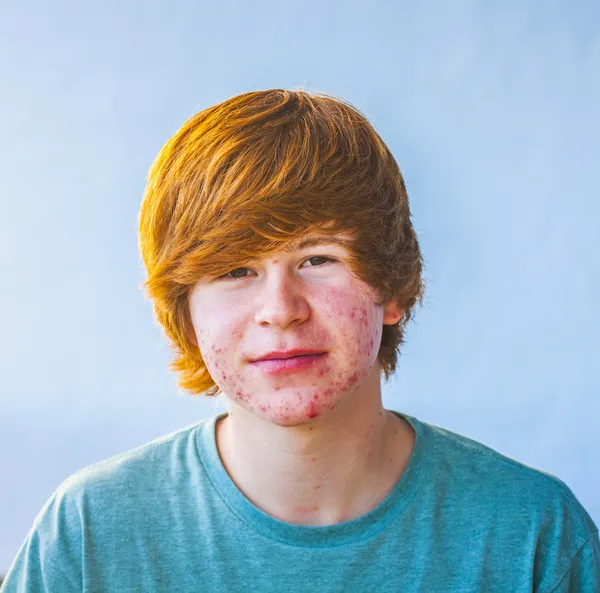 Smart boy in puberty with acne — Stock Photo, Image