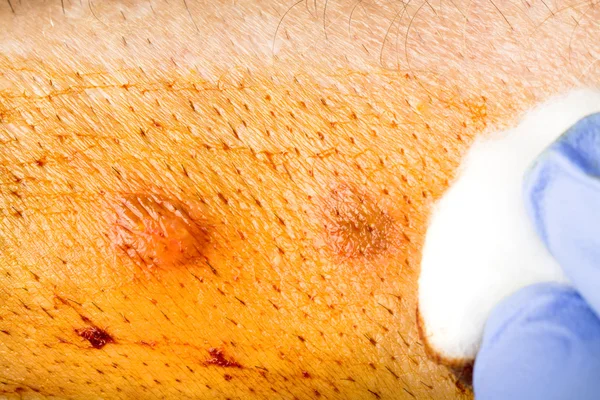 Cleaning wound — Stock Photo, Image