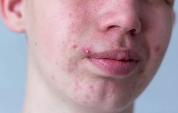 Uma foto de acne no rosto de um adolescente. Espinhas, cicatrizes vermelhas e pontos pretos nas bochechas e queixo. O conceito de problema pele, cuidado e beleza. — Fotografia de Stock