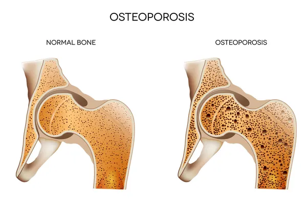 Osteoporosis — Stock Illustration Osteoporosis Stock Vector