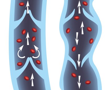 Normal vein and varicose vein clipart