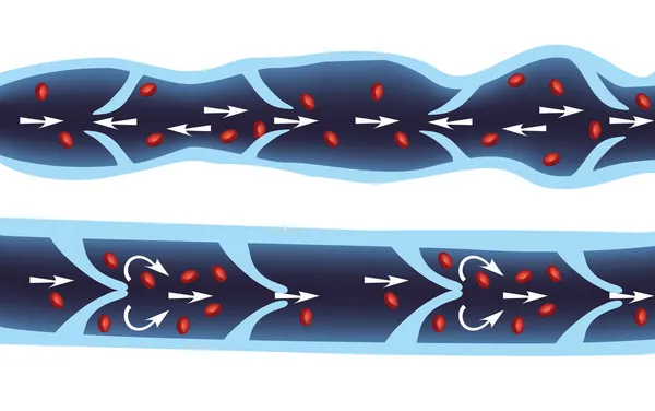 Vena normal y vena varicosa — Vector de stock