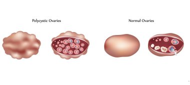 Vector Polycystic ovary and normal ovary differences clipart