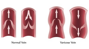 Varicose vein and normal vein illustration. clipart