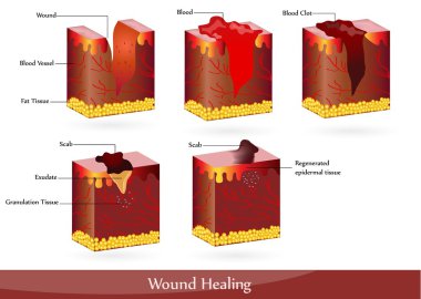 The process of wound healing clipart