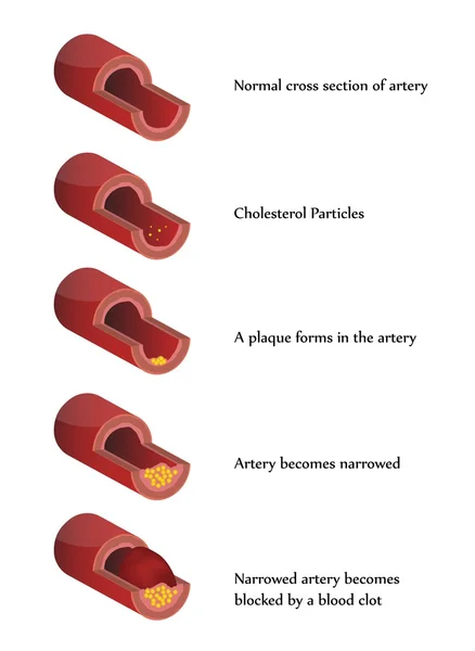 Ilustración de aterosclerosis del ector — Vector de stock