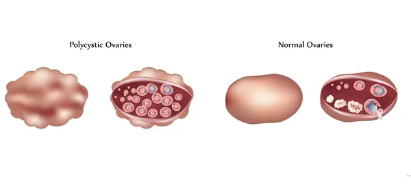 Vector Ovario poliquístico y ovario normal diferencias — Archivo Imágenes Vectoriales