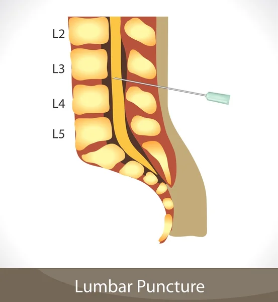 Lumbar puncture. — Stock Vector