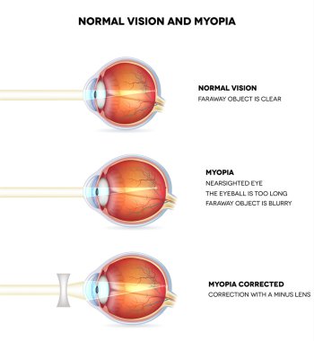 Myopia and normal vision. Myopia is being shortsighted. clipart