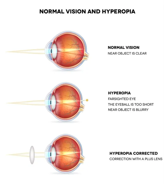 Hiperopia dan penglihatan normal. Hyperopia sedang rabun jauh . - Stok Vektor