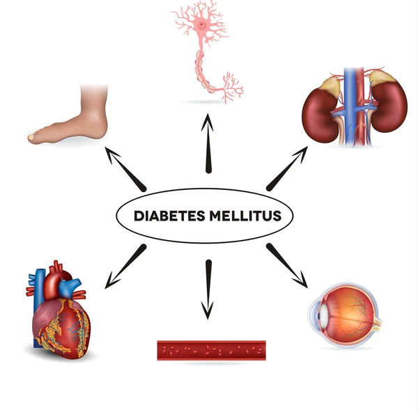 Mellitus de la diabetes — Vector de stock