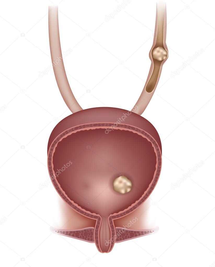 Stones in the urinary bladder and ureter. 