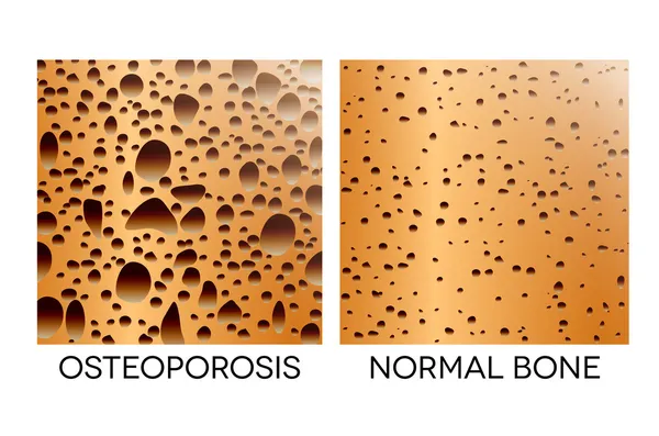 Osteoporóza, nezdravé kostí — Stockový vektor